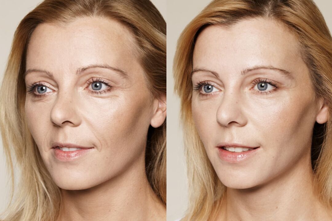 Ervaring met het gebruik voor en na het gebruik van de intenskin-crème van Valeria